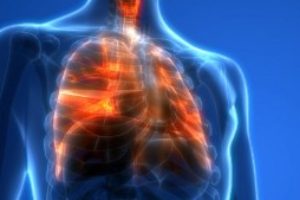 Lunginflammation - Luftvägsinfektioner