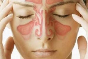 Bihåleinflammation - Luftvägsinfektioner