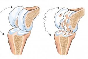 muskelreumatism behandling -muskelreumatism orsak