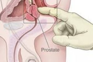 prostata inflammation symptoms - prostate
