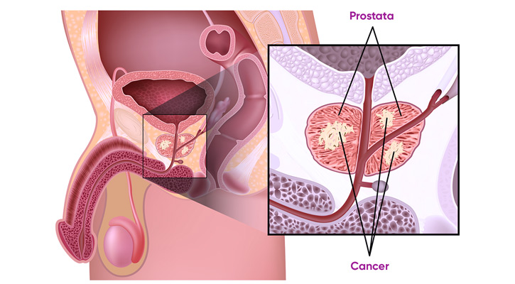 Prostatacancer - Symtom prostatacancer 