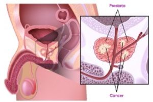 Prostatacancer - Symtom prostatacancer