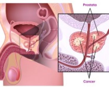 Prostatacancer - Symtom prostatacancer