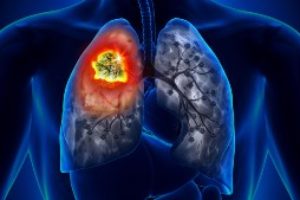 Lungcancer - Information om Lungcancer