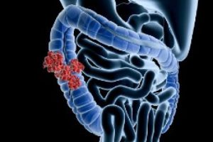 tjocktarmscancer symtom - Fakta och sjukdomstecken