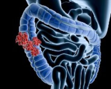 tjocktarmscancer symtom - Fakta och sjukdomstecken